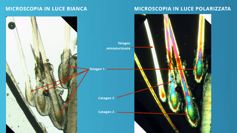 cura calvizie - le immagini del microscopio a luce polarizzata